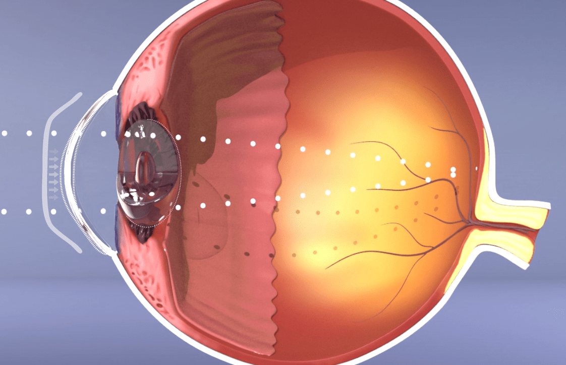 Orthokératologie ortho-k