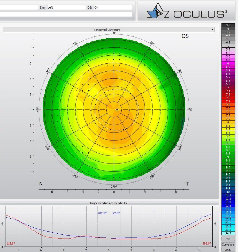 Orthokératologie ortho-k