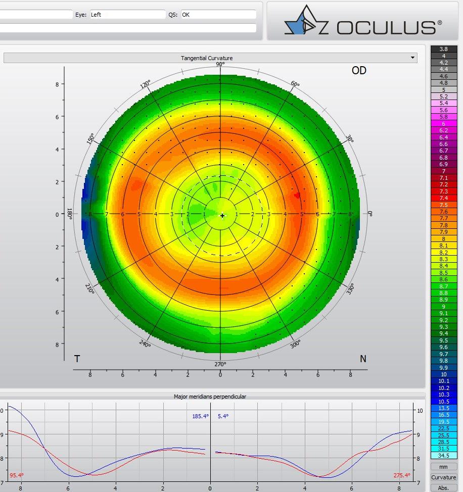 Orthokératologie ortho-k
