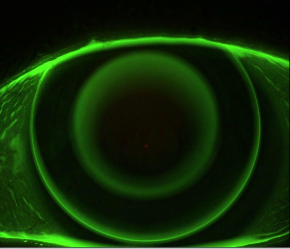 Orthokératologie ortho-k